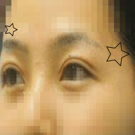 절개법 쌍커풀 수술 후 여성의 모습