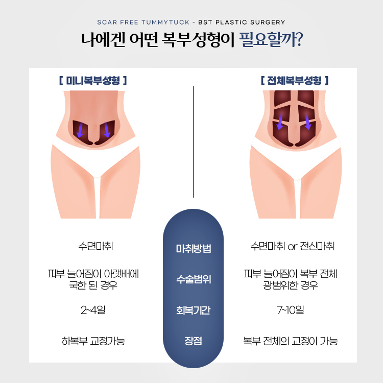 나에겐 어떤 복부성형이 필요할까? 
미니복부성형와 전체복부성형의 특징