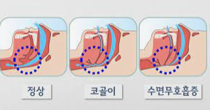 코골이 치료법