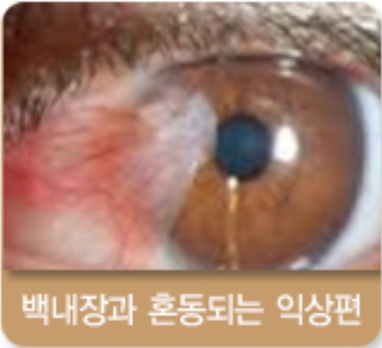 백내장 초기증상