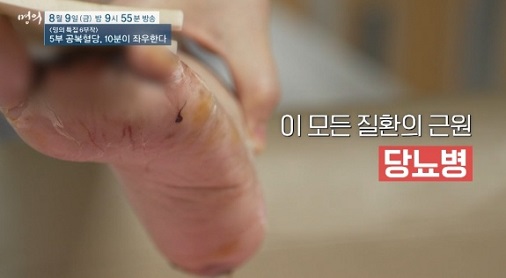 당뇨발괴사