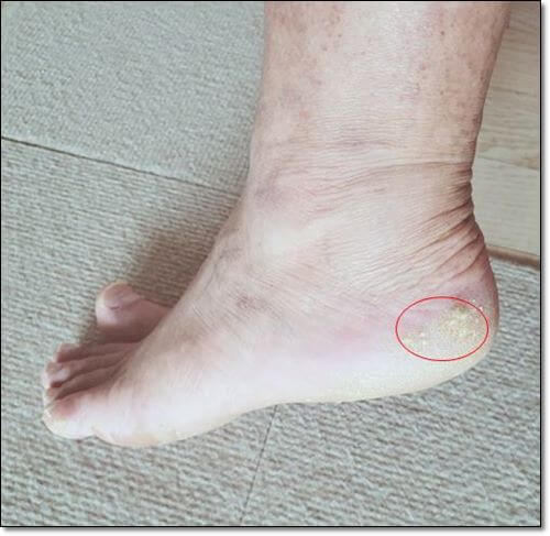 발뒷꿈치 티눈과 굳은살