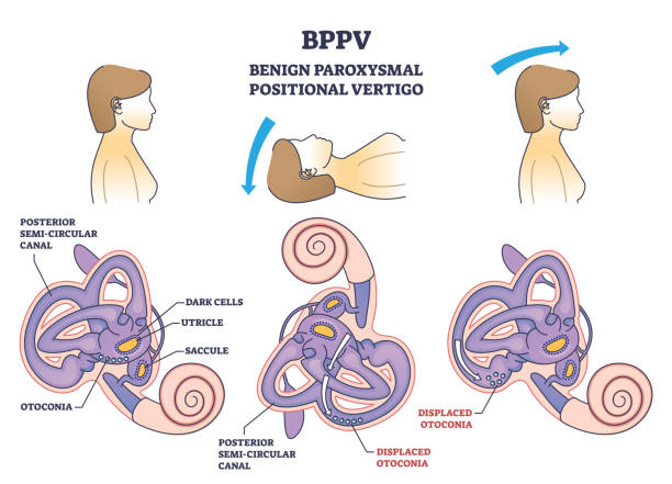 이석증 증상 어지럼증 어지러움 치료법 원인 자가치료 에 좋은 음식 병원 치료 약 운동 bppv 검사 수기법 epley 정복술 자가치료법 치료법 재발 막는 법 후유증 운동법 자가치료 방법