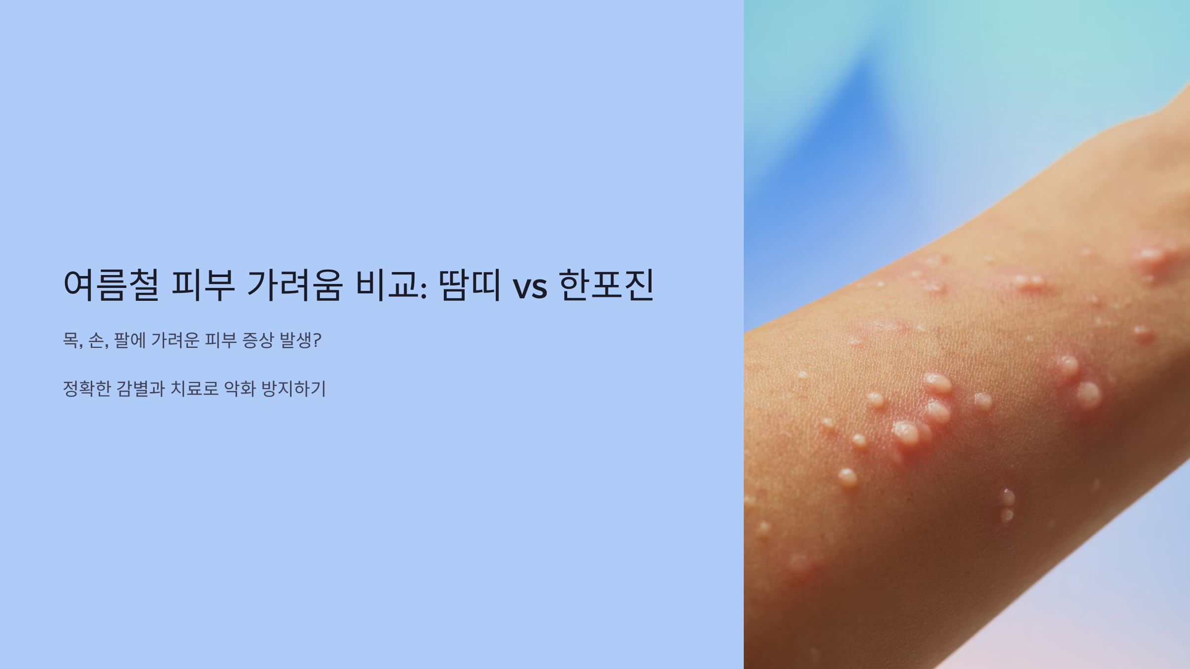 여름철 피부 가려움 비교: 땀띠 vs 한포진