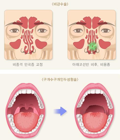 수면무호흡증의 수술적 치료