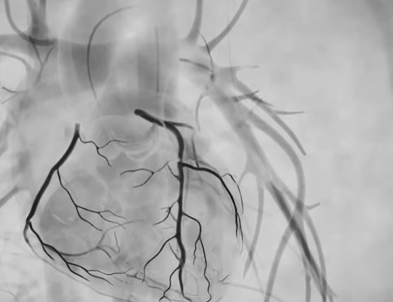 관상동맥 조영술