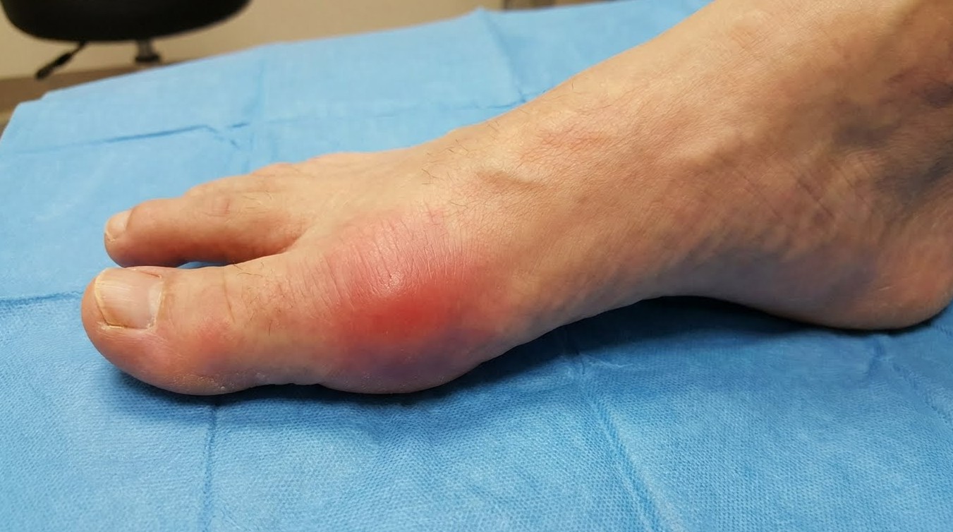 엄지발가락 관절 부위가 붉게 붓고 염증이 심한 발 클로즈업 사진
