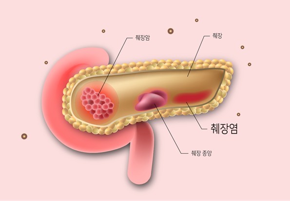 급성-췌장염