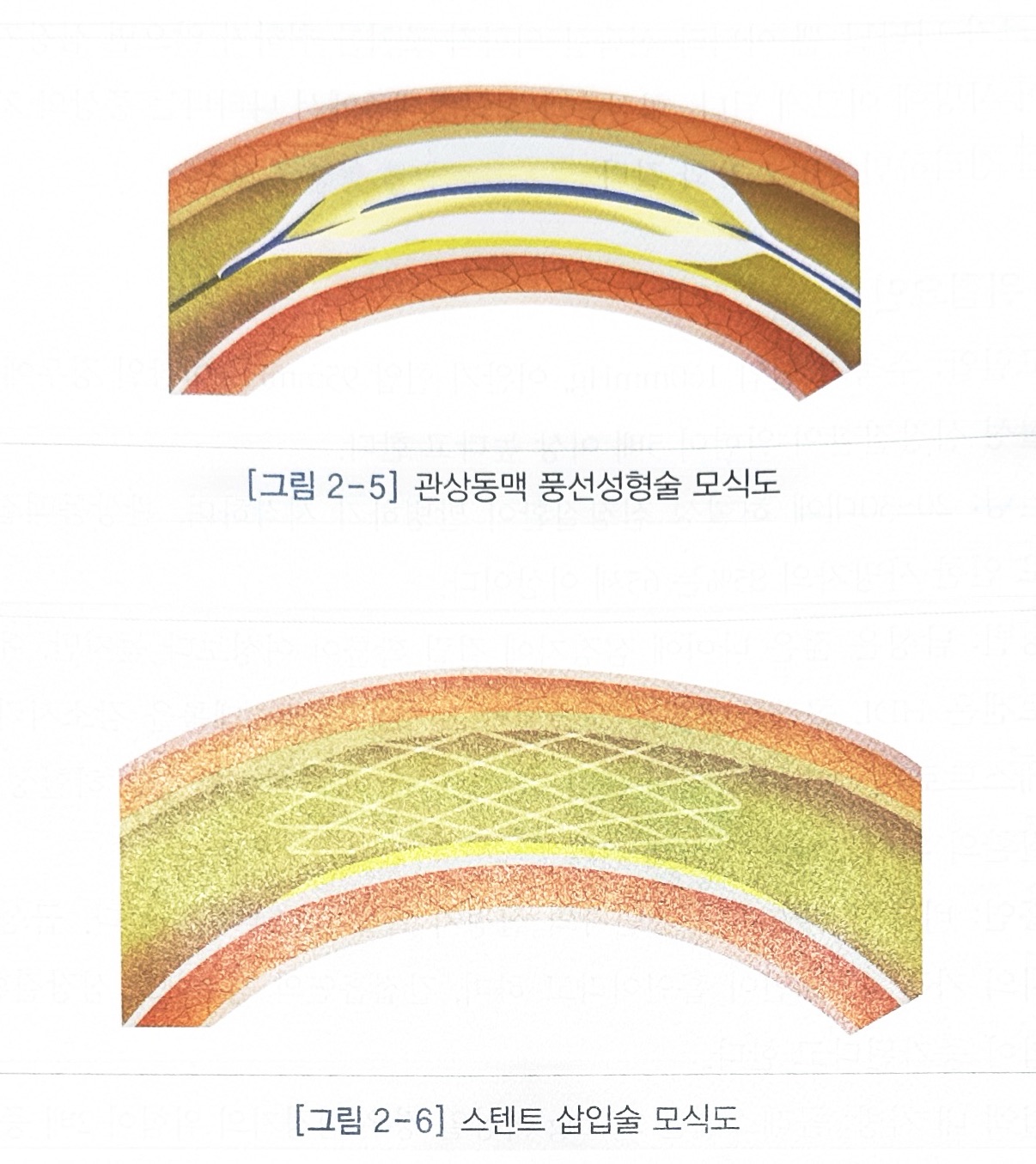 허혈성 심장질환