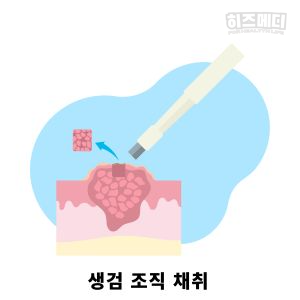 장상피화생