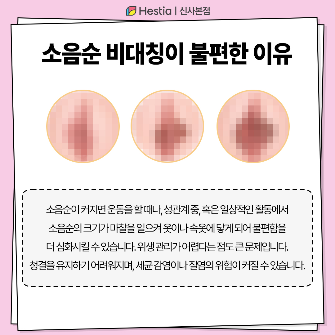 소음순 비대칭이 불편한 이유는?
