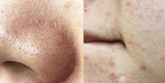 블랙헤드-피지-여드름