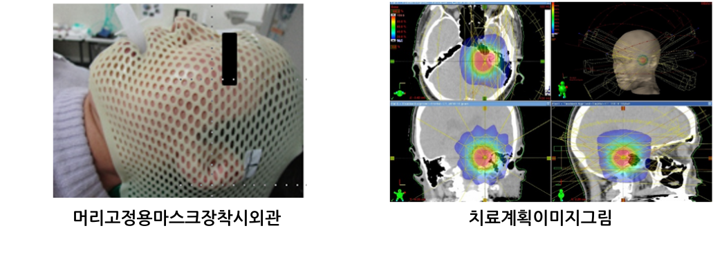 정위방사선치료(SRT/SBRT)