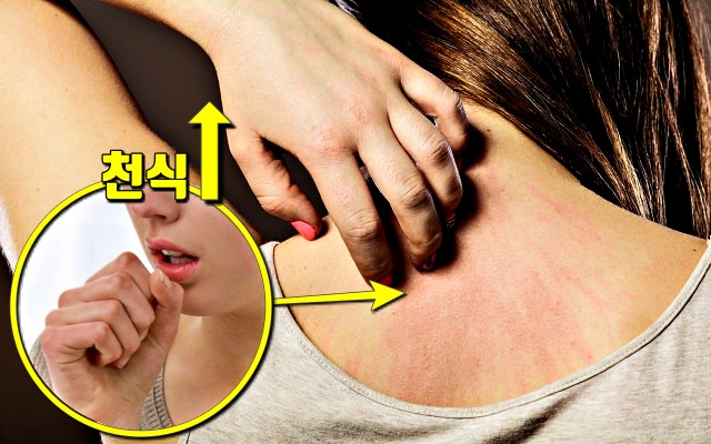 피부 알레르기,아토피 원인,생로병사의비밀