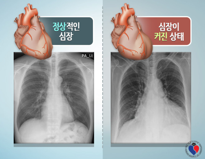 심장비대