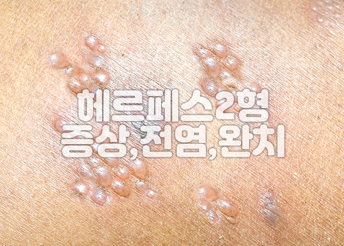헤르페스 2형으로 인한 수포 이미지