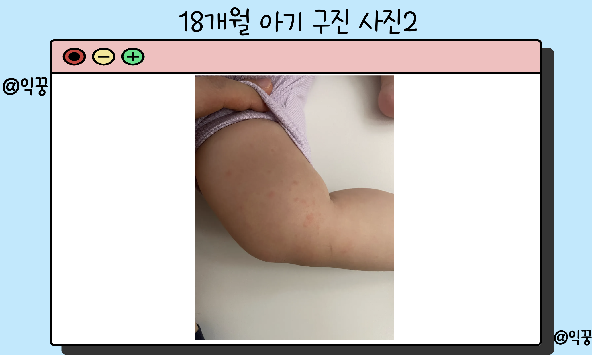 구진 뜻 발생 원인 치료 및 예방법2