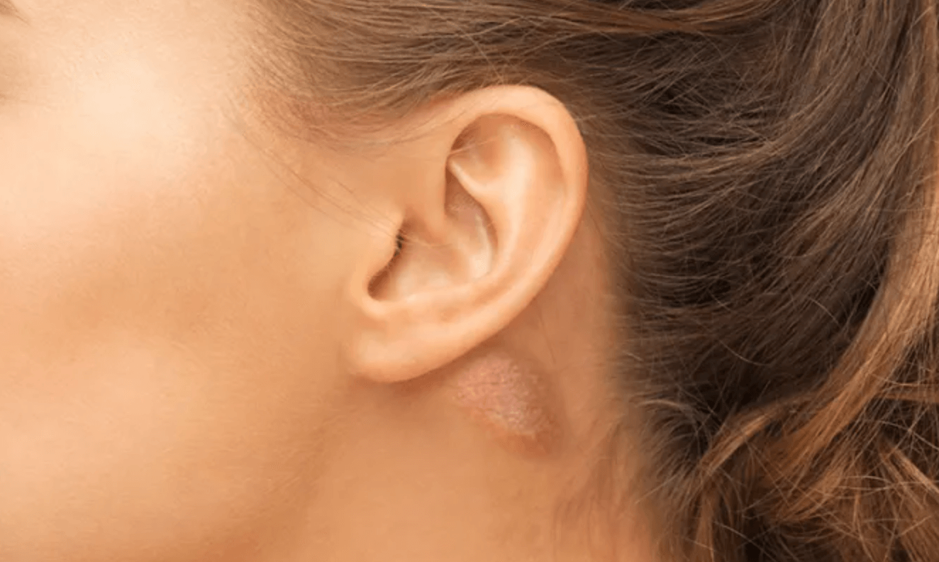 귀뒤 멍울 임파선