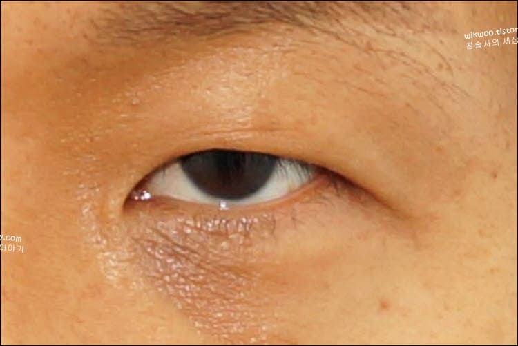안검하수 눈