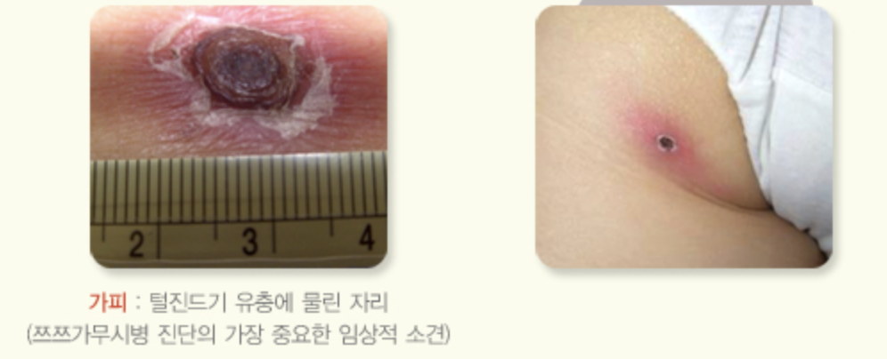 쯔쯔가무시 물린자국