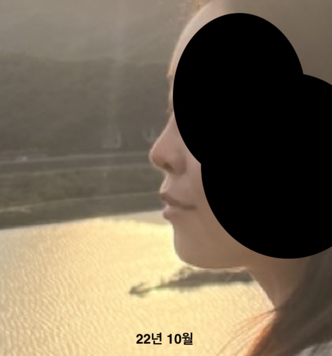 2년 7개월 교정 중 과개교합 돌출입 교정 일기