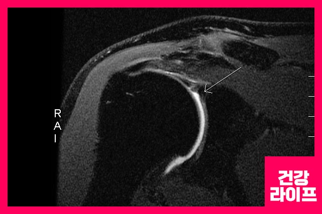 회전근개파열 증상에 대한 보존적 치료법