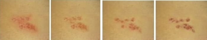 대상포진에의한-피부병변의변화