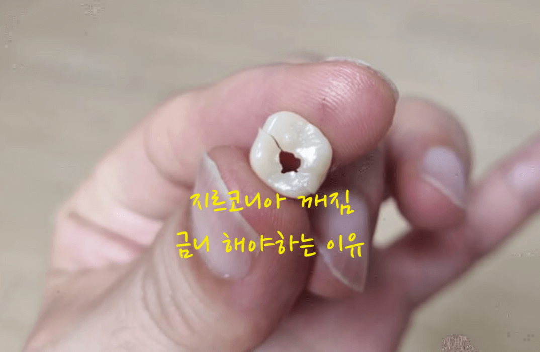 지르코니아 깨짐