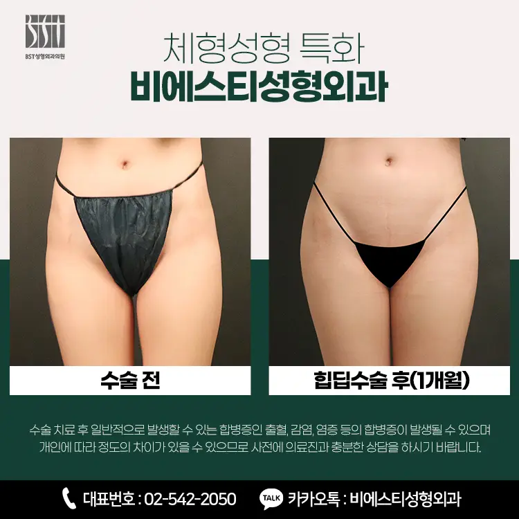비에스티성형외과 골반지방이식 힙딥성형 수술 환자 전후 비교