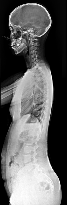 whole spine LAT