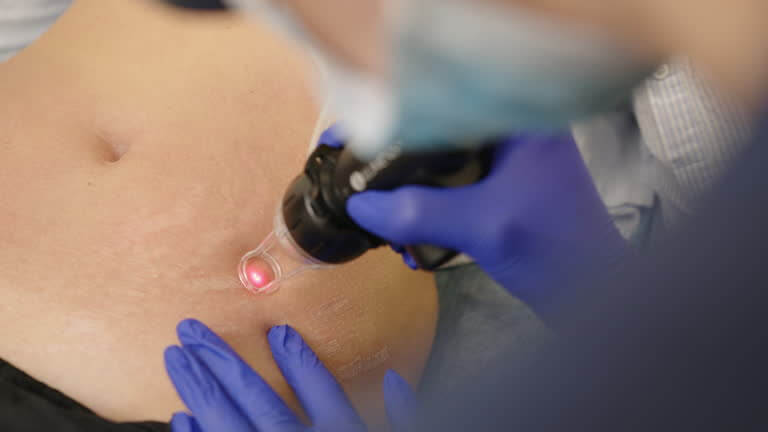 튼살 확실히 없애는 방법? 최신 피부과 시술부터 생활습관까지!