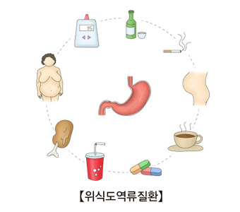 역류성식도염 증상