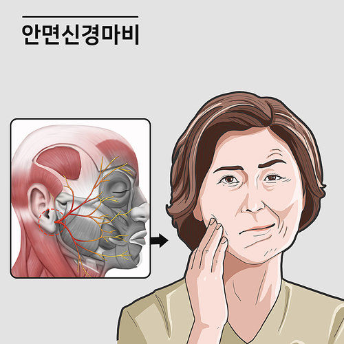 안면마비 초기대응 (골든타임, 치료법, 예방연구)
