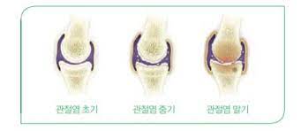 콘드로이친 1200mg 가격 효능 (내돈내산 후기)
