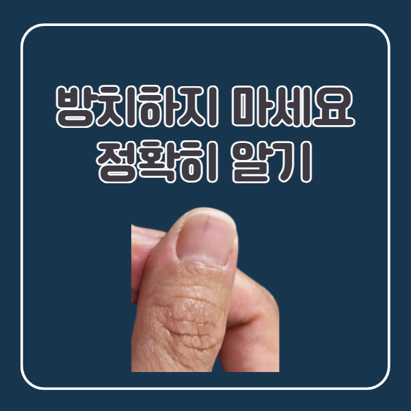 손톱 밑 검은줄 방치하면 생기는 문제들