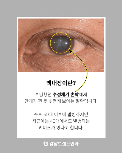 백내장 증상과 안과 병원 추천