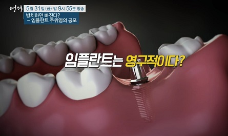 임플란트는영구적이지않다