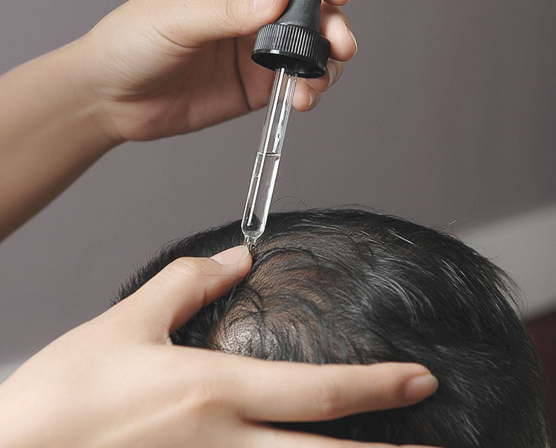 줄기세포 탈모 치료 시술 중인 환자