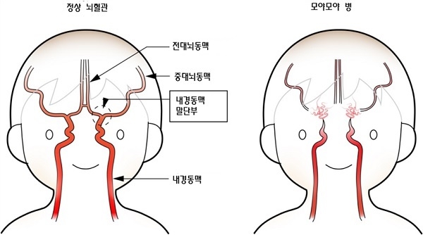 모야모야병을 설명하는 사진