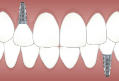 65세이상-임플란트-정부지원-받는방법