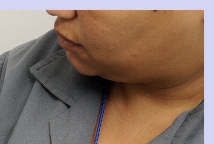 대상포진 치료기간