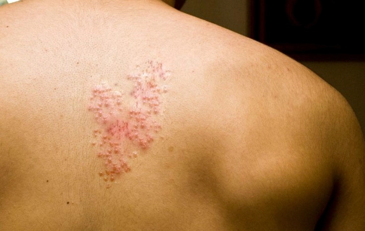 대상포진 전염성