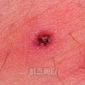 쯔쯔가무시 물린자국