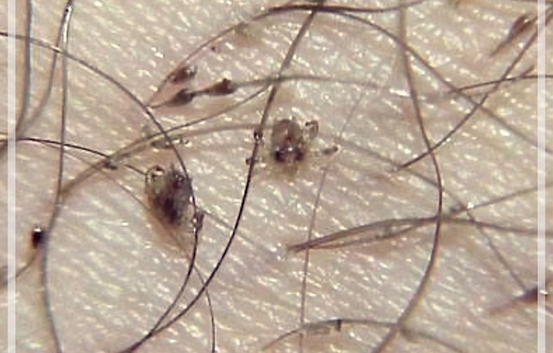 사면발이: 증상, 치료 방법, 그리고 전염성