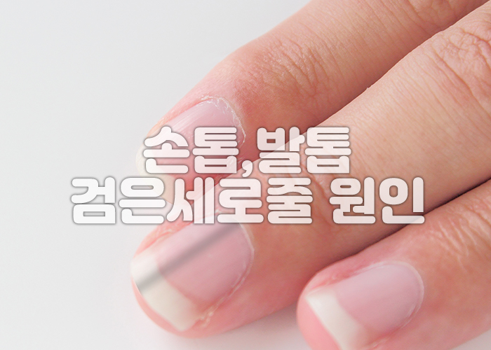 중지 손톱에 검은색 세로줄이 보여진다