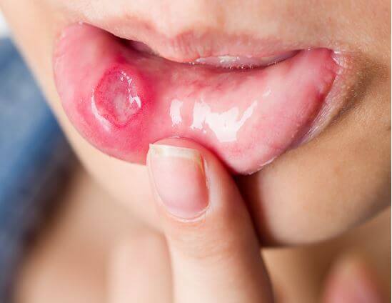 입안에 구내염이 생긴 모습