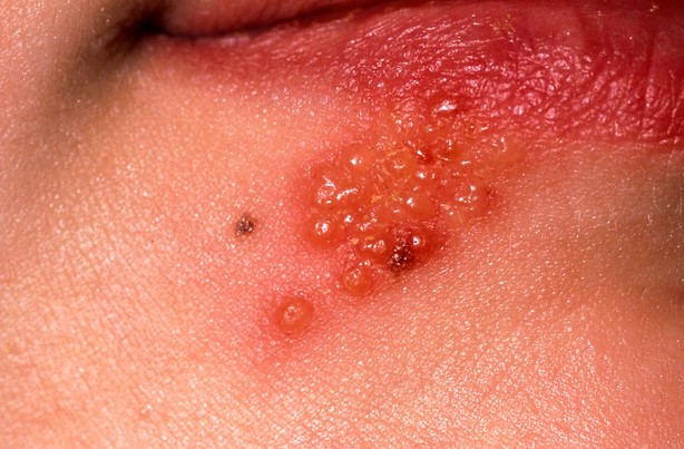 헤르페스 1형 전염과 원인