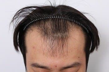모발이식 후기