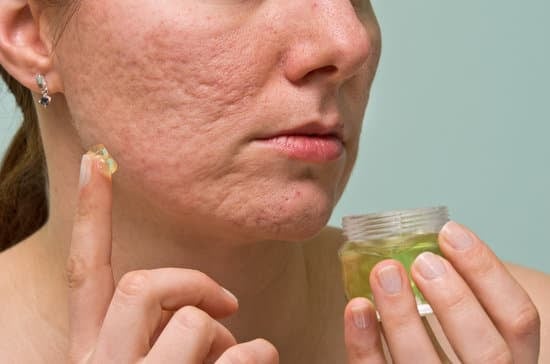 여드름 치료 국소 항생제 (Topical Antibiotics)