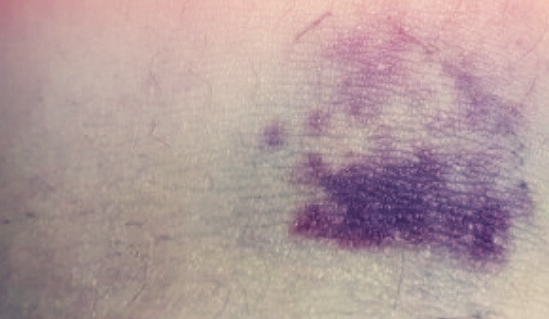 피부에-생긴-보라색-멍자국